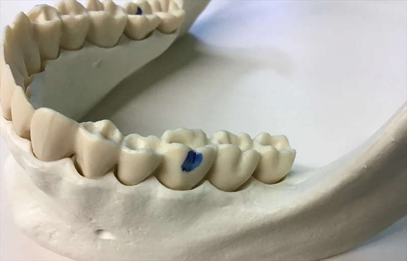 Cavity Prevention for Kids: What Rochester Hills Parents Need to Know image