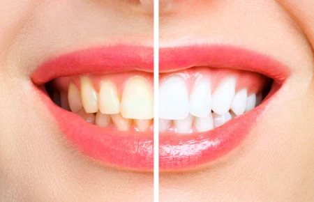 Teeth Whitening Methods image
