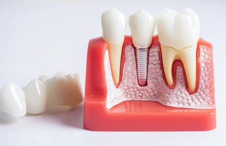 How Long Do Dental Implants Last? Maintenance Tips for a Lifetime of Smiles image