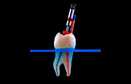 Root Canal Treatment image