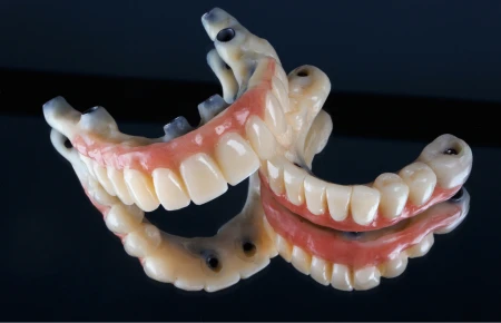 Understanding the Full Dental Implant and Restoration Process image