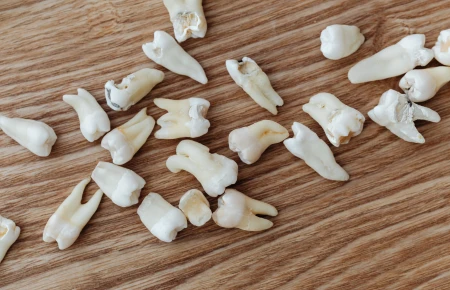 What is a Tooth Cavity image