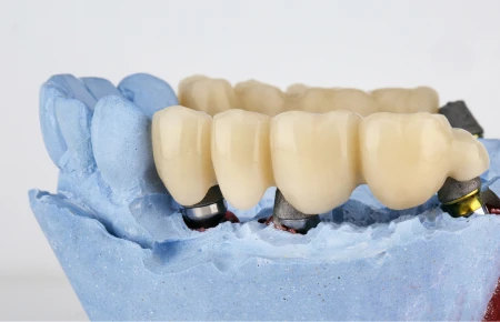 Dental Bridges image