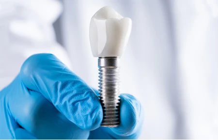 Three Benefits of Dental Implants image