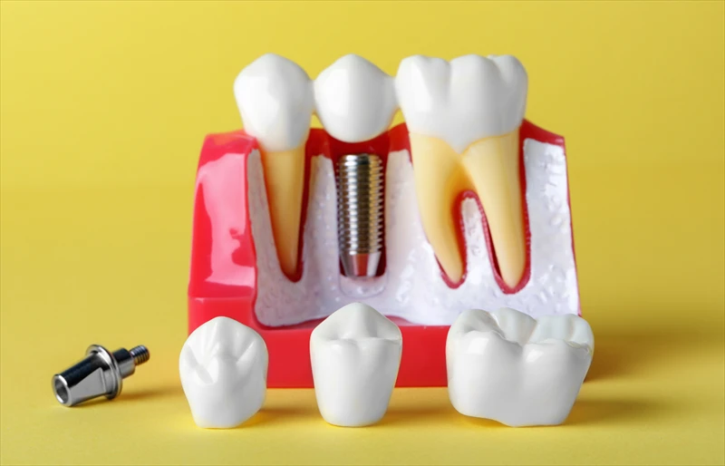 Dental Implant Surgery: How Technology Makes It Faster and Safer image