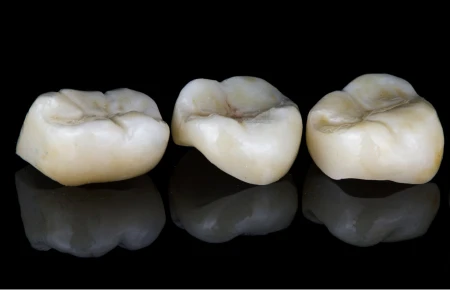 What Happens During a Dental Crown Procedure image