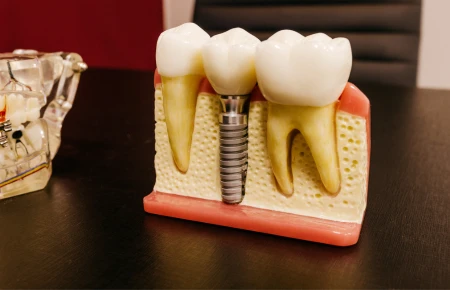 Consider Dental Implants for Replacing a Missing Tooth image