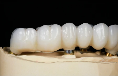 The Evolution of Dental Implants in 2024: Guide from River square Family dentist image