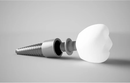 How to Care for Your Dental Implants: Tips for Long-Lasting Results image