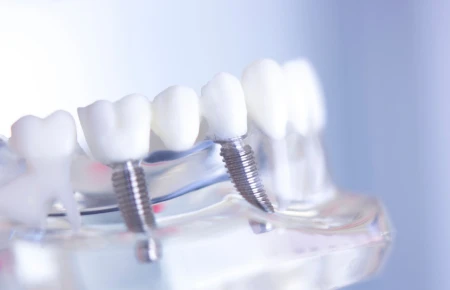 Future Trends in Dental Implants: Biomaterials and Biocompatibility image