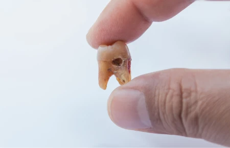 What Causes Tooth Decay image