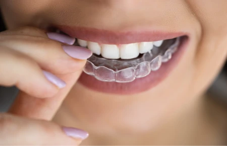 Invisalign Treatment image