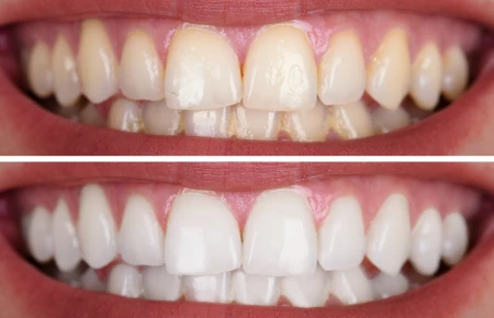 Teeth Whitening Types image