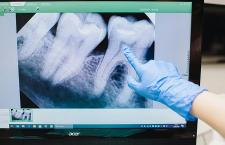 Tooth Decay Stages image