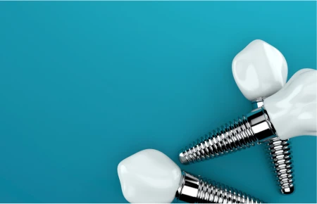 Step-by-Step Procedure for Full Mouth Dental Implants image