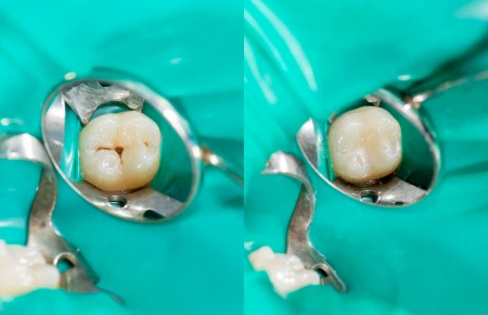 What Are Dental Sealants image