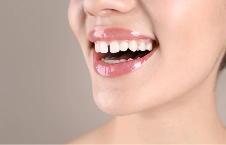 When To Use Space Maintainer on Teeth image