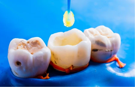 Which Dental Filling Is Better image