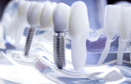 The Benefits of Dental Implants: Why They Are the Best Choice for Missing Teeth image