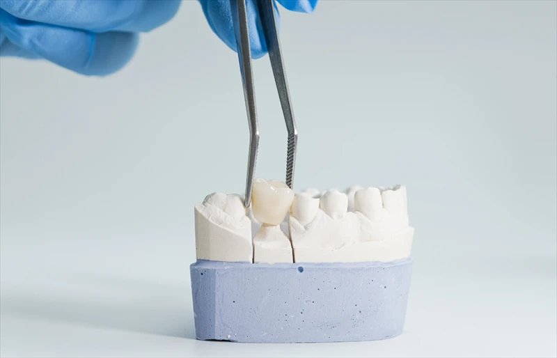 Mini Dental Implants vs. Traditional Implants: What’s the Difference? image