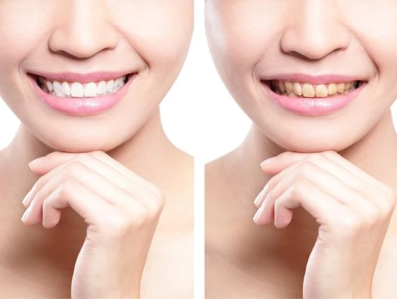5 Surprising Factors That Can Affect Teeth Whitening Results