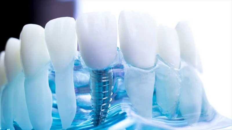 Implant Aesthetics: Crafting Authentic Smiles with Dental Implants in NY