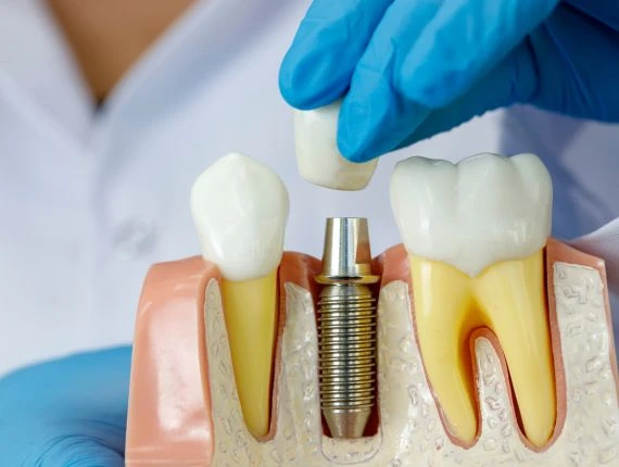 How to Care for Your Dental Implants
