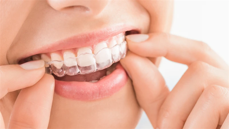 Maintaining Oral Hygiene with Invisalign: Tips for Wasilla Patients 