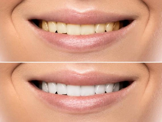 The Pros and Cons of Teeth Whitening: Is It Worth It?