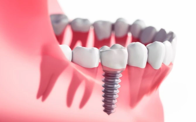 Everything You Need To Know About Dental Implants