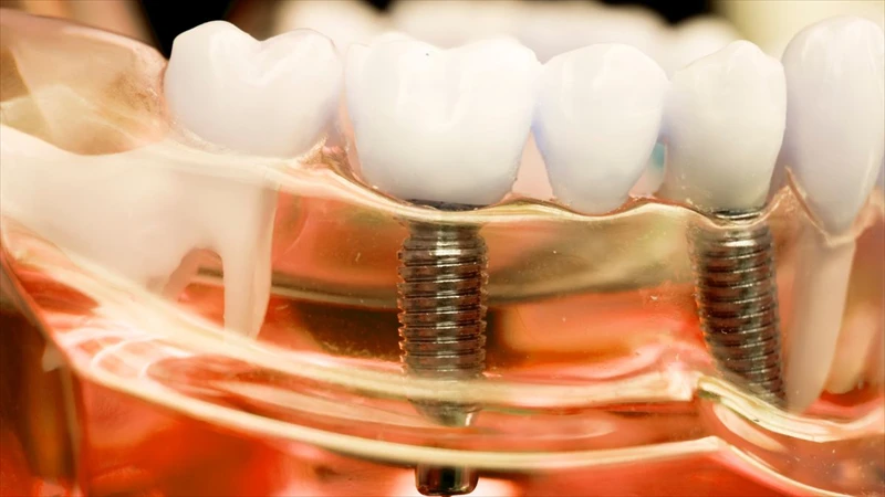 Embracing Change: Why Dental Implants Trump Dentures for Tooth Replacement in NY