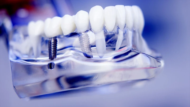 The Path to Self-Assured Grins: A Deep Dive into the Dental Implant Process in NY