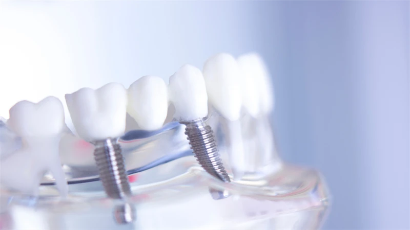 Dental Implants in Wasilla: A Permanent Solution to Tooth Loss 