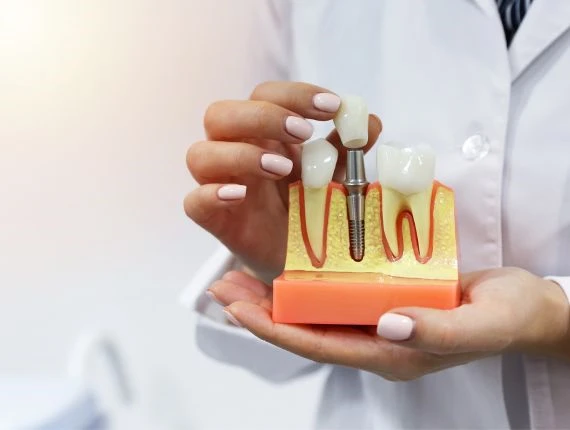 The Benefits of Dental Implants